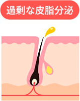 皮脂の過剰分泌