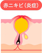 赤ニキビ