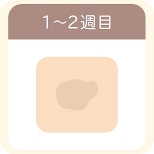 シミ取りレーザー照射後1～2週間目、かさぶたがはがれた後のピンク色の皮膚