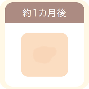 シミ取りレーザー照射後約1ヵ月後、ピンク色の皮膚が徐々に周囲となじんできている状態